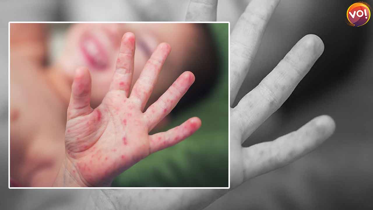 Spike in Hand Foot Mouth Diseases Leads to Demand For Online Classes