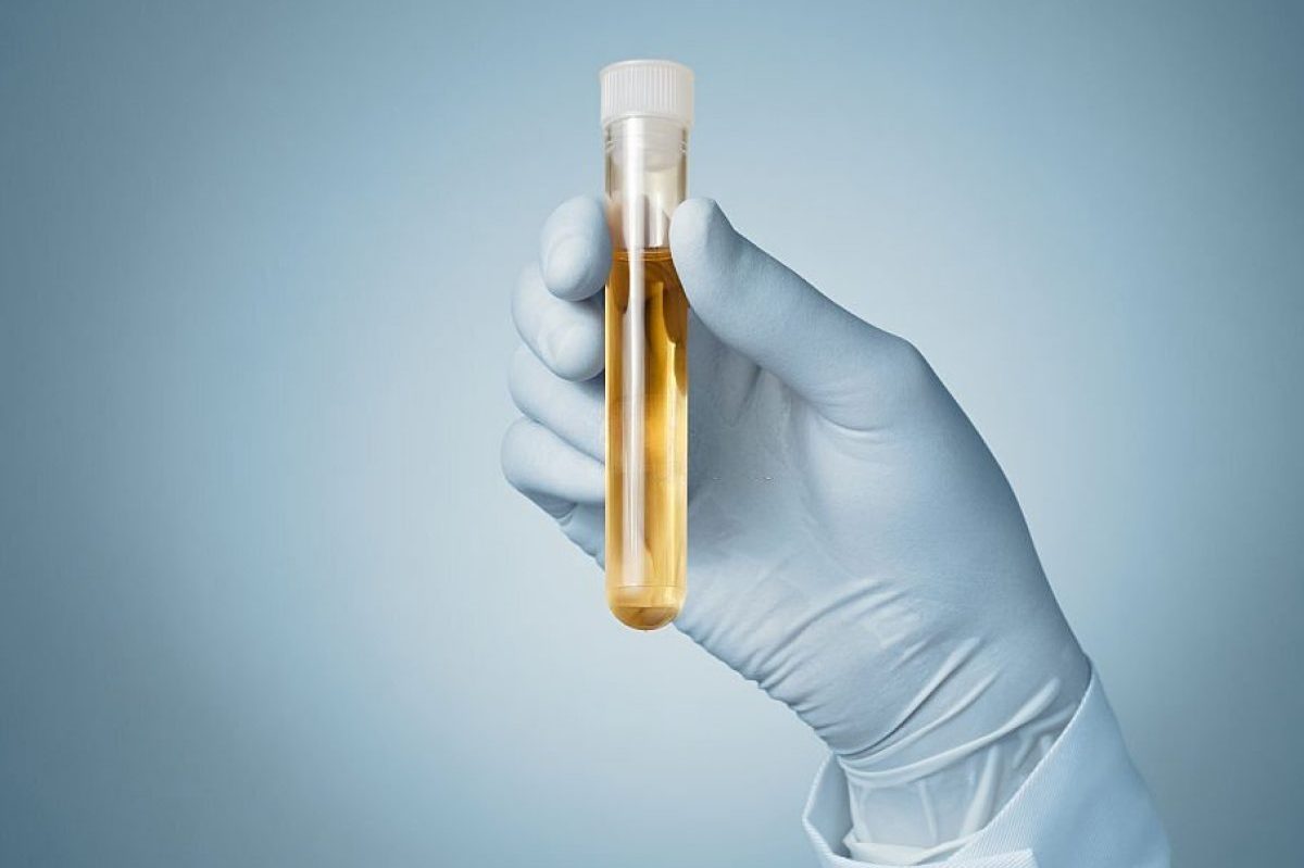 When Should You Get Your Urine Test Done?