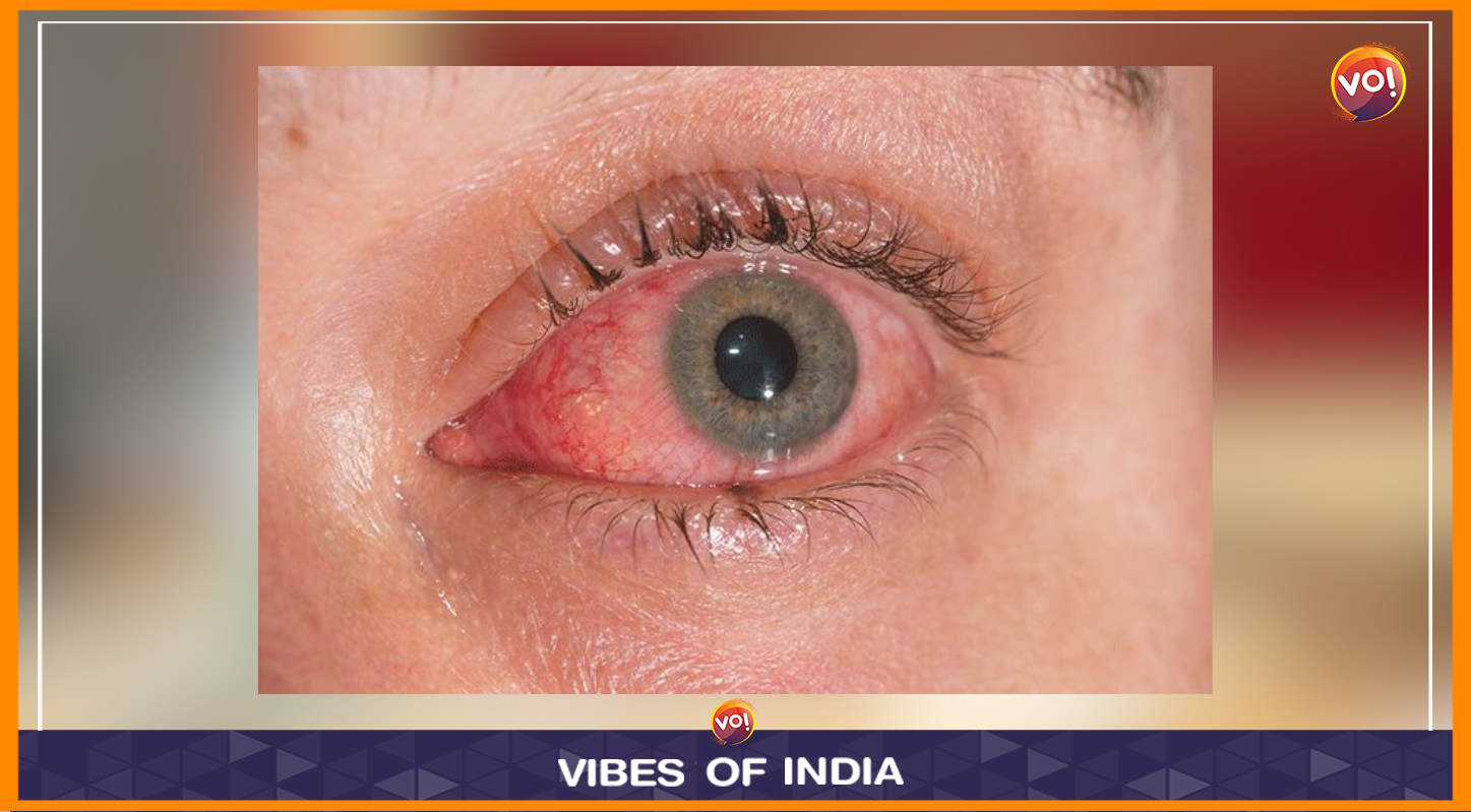 Eying Remedy: Govts Ask Conjunctivitis-Hit To Stay Indoors, Docs Stress Hygiene