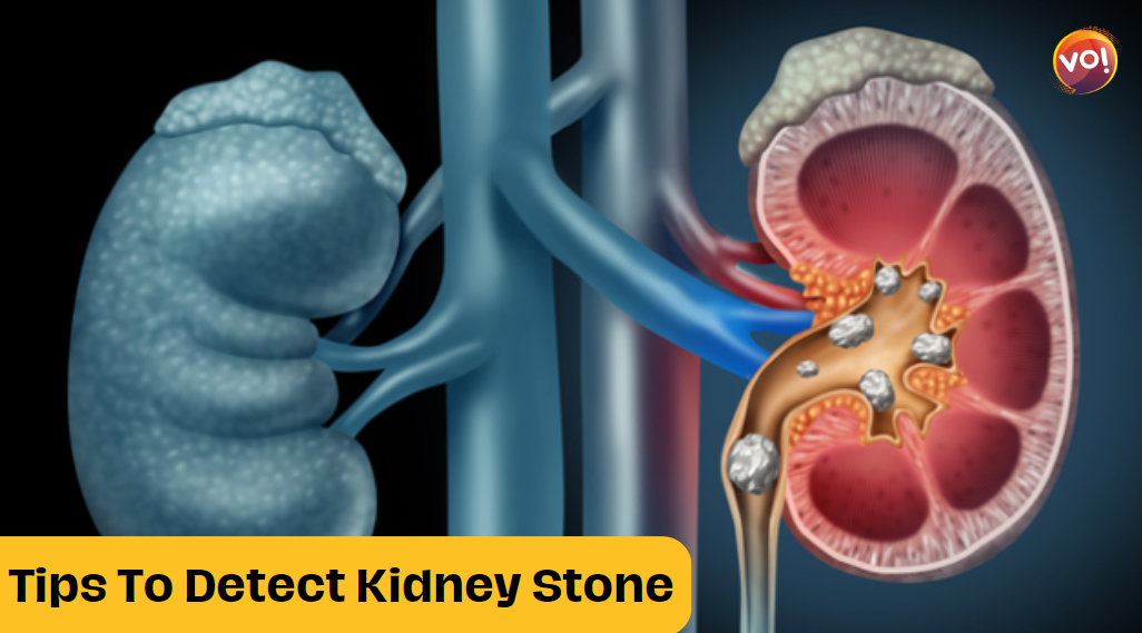 5 Key Symptoms Of Detecting Early Kidney Stones
