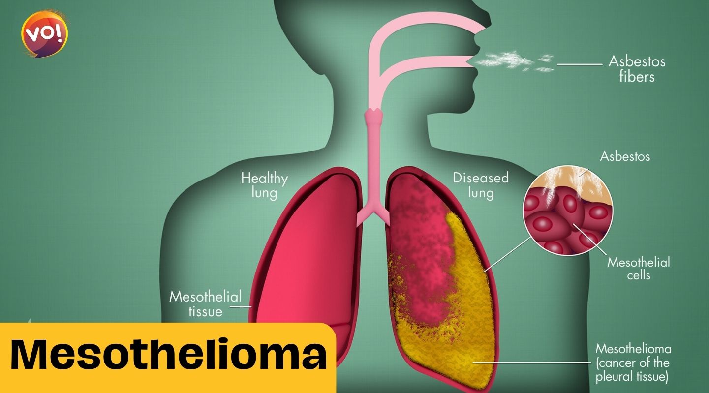 New Drug For Asbestos-Related Cancer Boosts Survival Rates, UK Study Finds