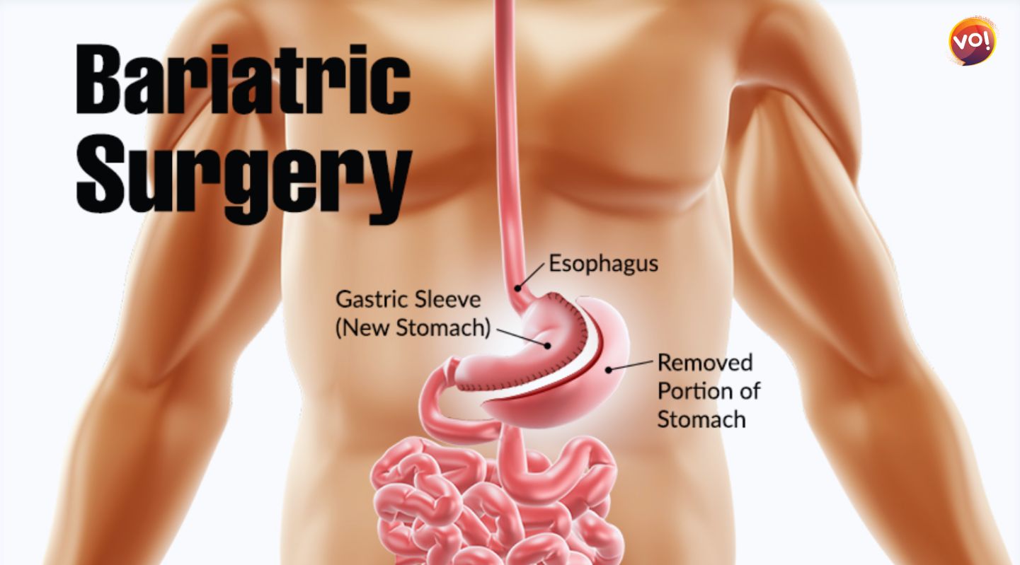 Ahmedabad: Rise in Bariatric Surgeries Among Youths
